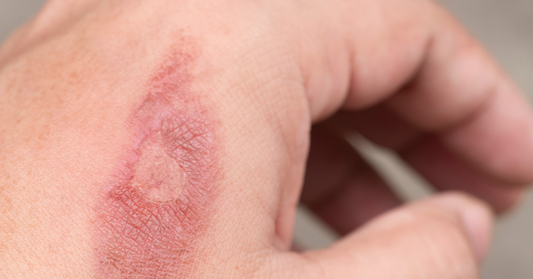 Burn Treatment