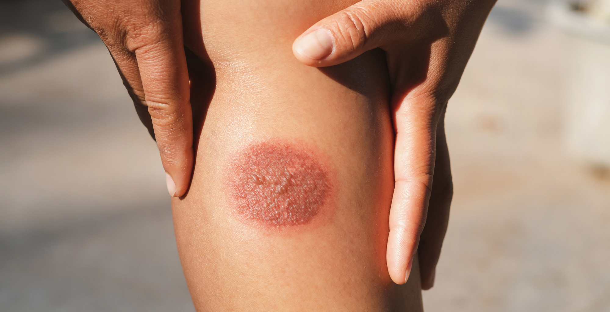 Dealing with Burn Injuries: First Aid and Effective Treatment